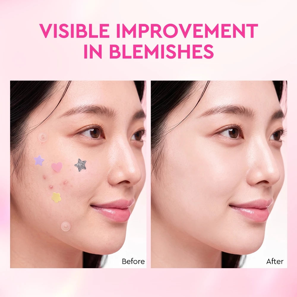 Salicylic Acid Gentle Absorbing Acne Patches